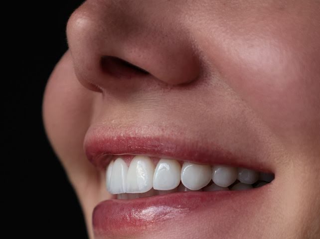 Lentes de contato dental na Ambrózio Odontologia, Anápolis