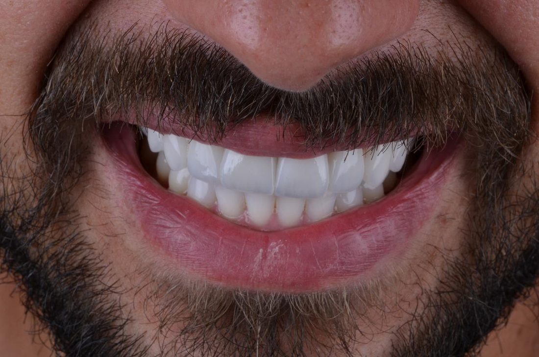 Prótese dentária na Ambrózio Odontologia, Anápolis